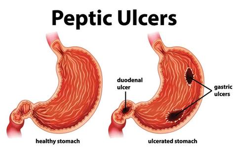 Peptic Ulcer disease symptoms