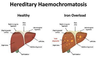 Haemochromatosis symptoms