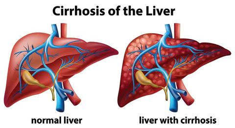 Cirrhosis in the Liver