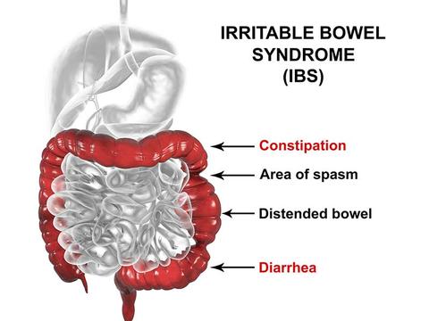 IBS Symtoms