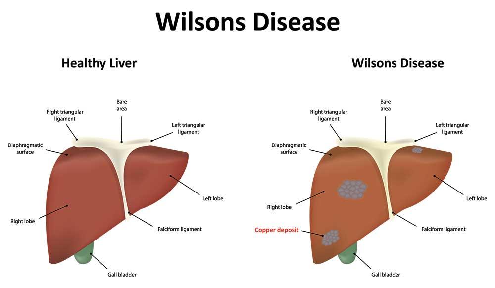 Wilsons Disease sympotms